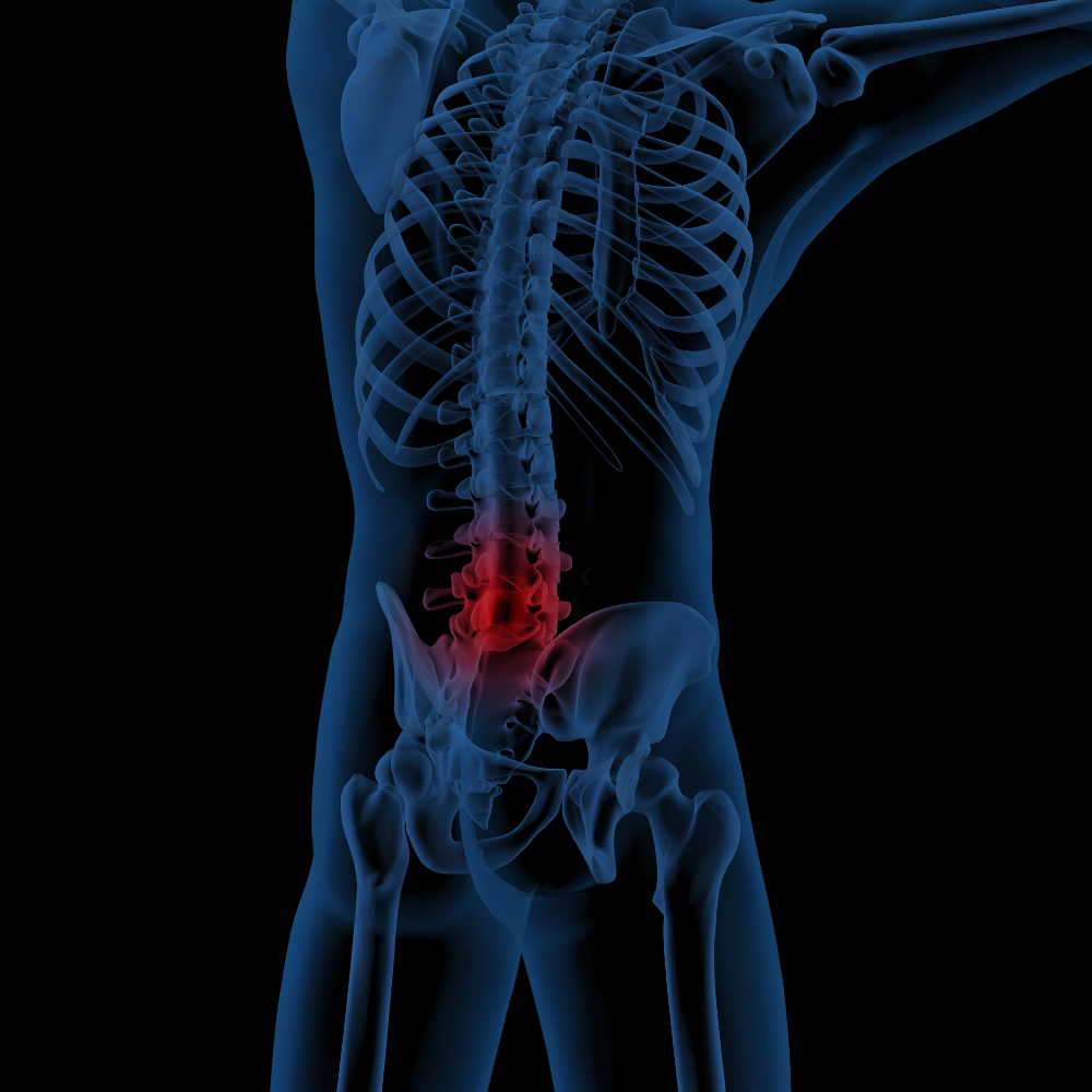 Canal lombaire étroit