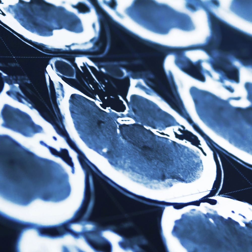 reparation-osteo-durale